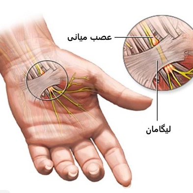 آگاه‌سازی پرسنل هلدینگ عظام درباره‌ی راه‌های پیشگیری از سندرم تونل کارپال